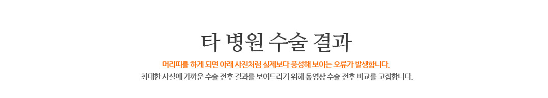 타 병원 수술 결과 머리띠를 하게 되면 아래 사진처럼 실제보다 풍성해 보이는 오류가 발생합니다. 최대한 사실에 가까운 수술 전후 결과를 보여드리기 위해 동영상 수술 전후 비교를 고집합니다.