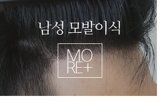 남성모발이식
