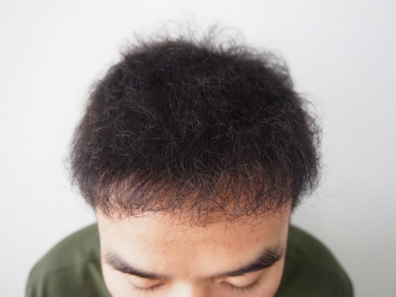 같은 작성자의 수술 후 8개월 정면 사진