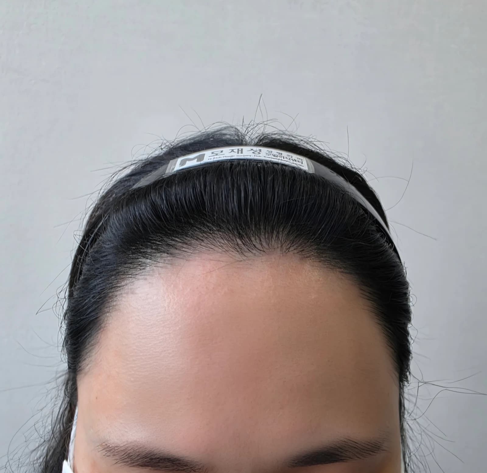 수술 후 1년 · 정면 헤어라인