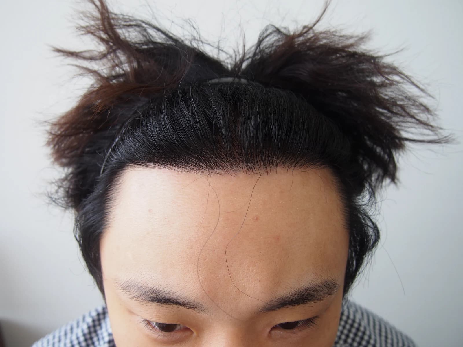 수술 후 사진