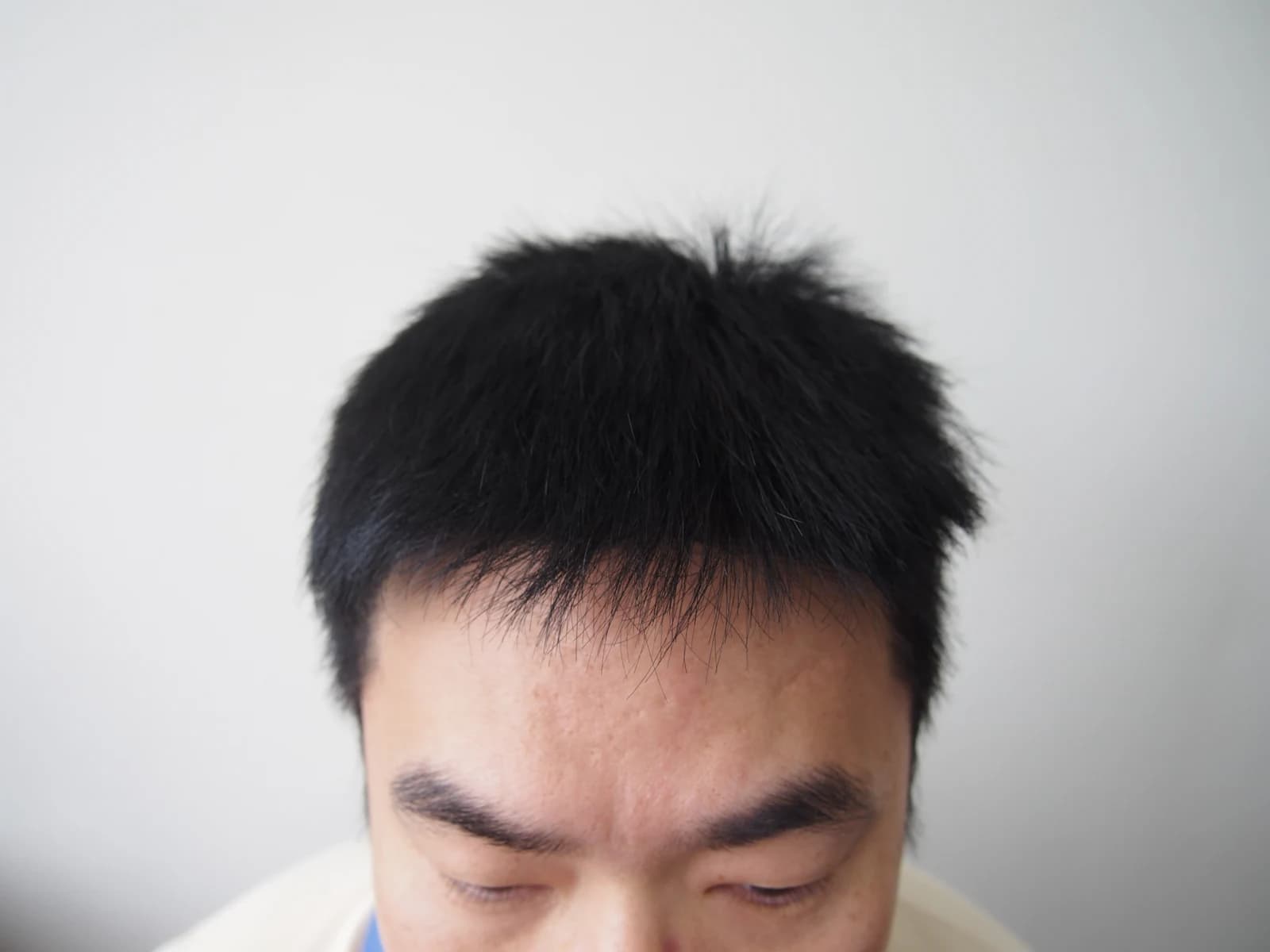 수술 후 사진