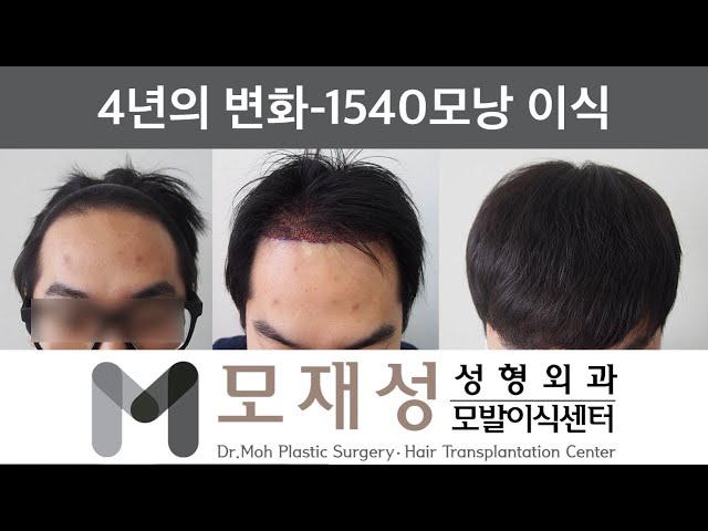 모재성의 탈모탈출! 비절개 넓은 이마라인 내리기 4년 비포&애프터 - 1540모낭 이식 영상 미리보기 배경