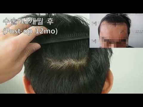 FUE Hair transplantation by Dr. Moh 영상 미리보기 배경