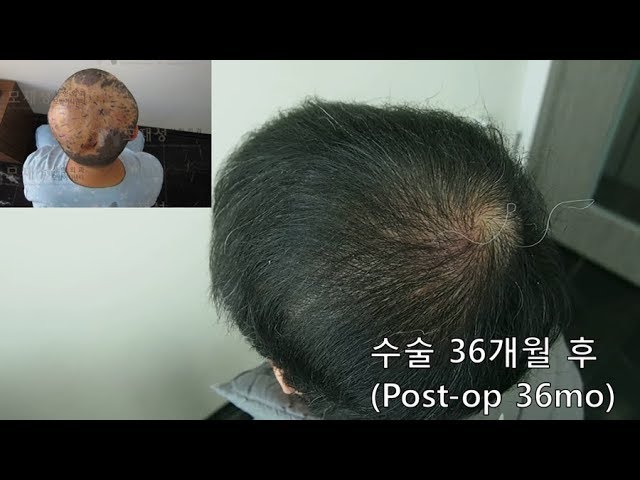 FUE Hair transplantation on scalp scar 영상 미리보기 배경