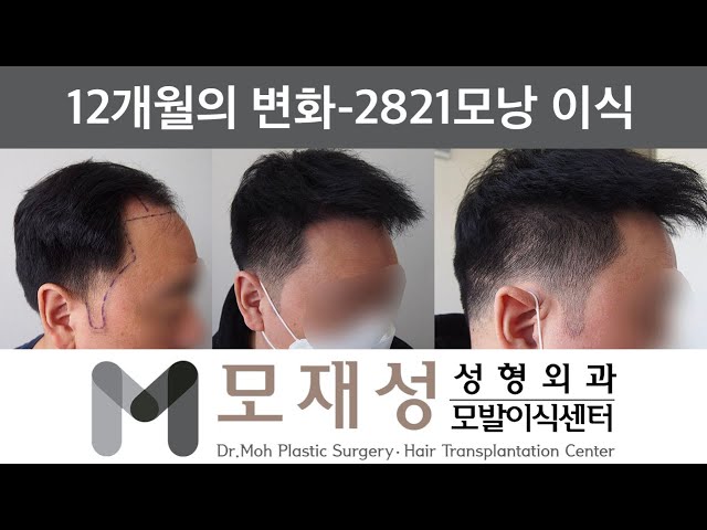 모재성의 탈모탈출! 비절개 전두부 및 측면 헤어라인 광범위 교정 12개월 비포&애프터 - 2821모낭 이식 영상 미리보기 배경
