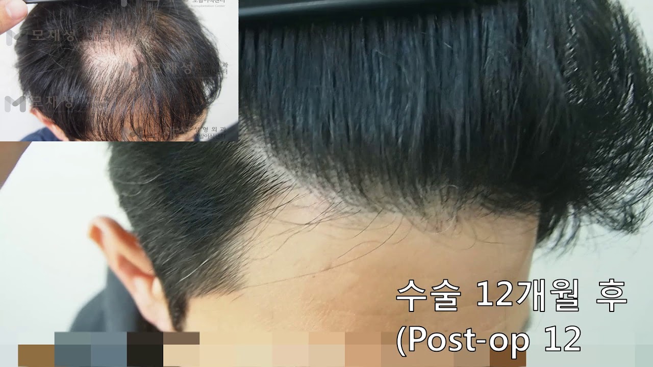 2차 FUE Hair transplantation by Dr. Moh 2ndary case. 영상 미리보기 배경