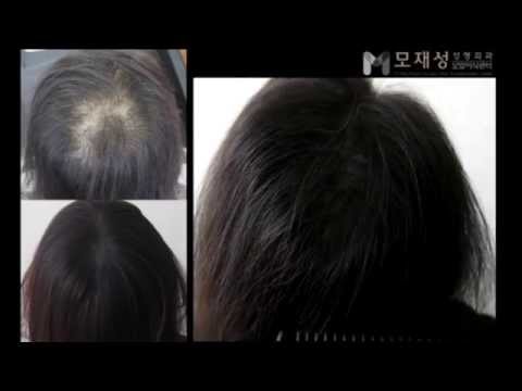 두피문신 시술전후 동영상 (scalp micropigmentation treatment) 영상 미리보기 배경