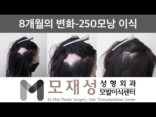 모재성의 탈모탈출! 두피흉터 비절개 모발이식 8개월 비포&애프터 - 250모낭 이식 영상 미리보기 배경
