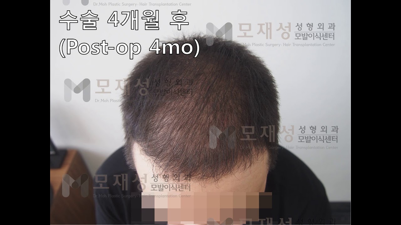 FUE Hair transplantation by Dr. Moh 영상 미리보기 배경
