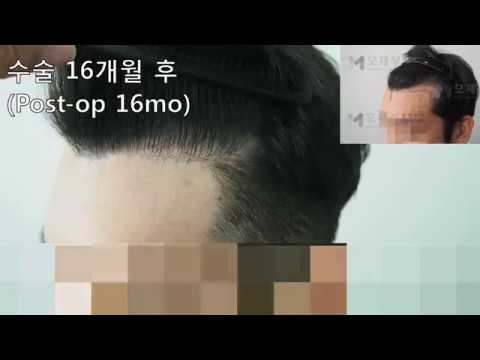 FUE Hair transplantation by Dr. Moh 1207graft(2149 hairs) 영상 미리보기 배경
