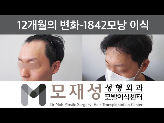 모재성의 탈모탈출! 비절개 넓은 M자 이마라인 내리기 1년 비포&애프터 - 1842모낭 이식 영상 미리보기 배경