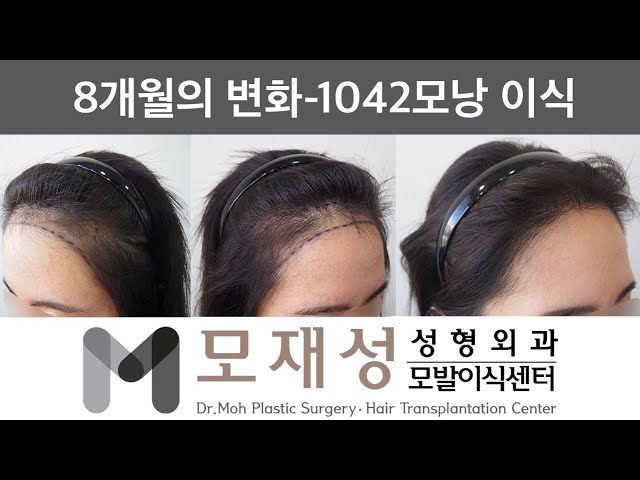 모재성의 탈모탈출! 비절개 여자 헤어라인 교정 8개월 비포&애프터 - 1042모낭 이식 영상 미리보기 배경