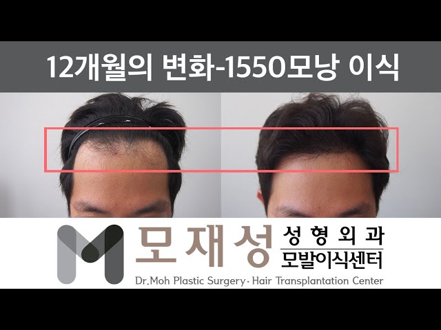 모재성의 탈모탈출! 비절개 넓은 이마라인 내리기 1년 비포&애프터 - 1550모낭 이식 영상 미리보기 배경