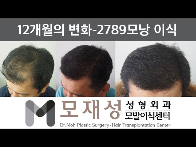 탈모탈출! 광범위 탈모 비절개 대량 모발이식 1년 비포&애프터 - 40대 후반, 2789모낭 이식 영상 미리보기 배경