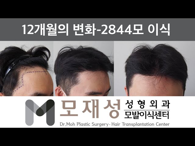 탈모탈출! 비절개 넓은 이마라인 내리기 1년 비포&애프터 - 31세 남성, 1325모낭 (2844모)이식 영상 미리보기 배경