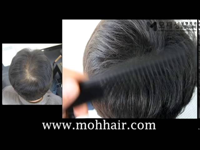 두피문신 시술전후 동영상 (scalp micropigmentation treatment) 영상 미리보기 배경