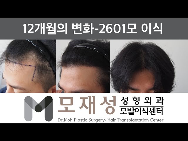 모재성의 탈모탈출! 비절개 모발이식 1년 비포&애프터 - 29세 남성, 1200모낭( 2601모 ) 이식 영상 미리보기 배경