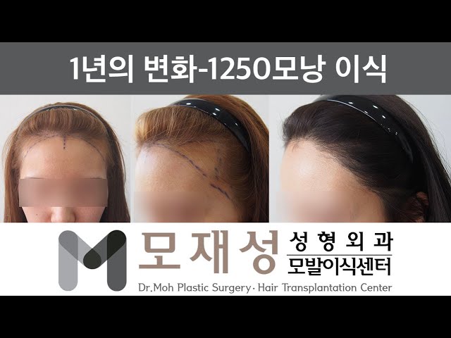 모재성의 탈모탈출! 비절개 여자 헤어라인 교정 12개월 비포&애프터 - 1250모낭 이식 영상 미리보기 배경