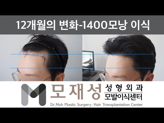 모재성의 탈모탈출! 비절개 넓은 M자 이마라인 내리기 1년 비포&애프터 - 1400모낭 이식 영상 미리보기 배경