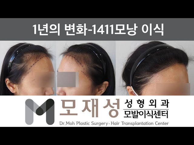 모재성의 탈모탈출! 비절개 여자 헤어라인 교정 12개월 비포&애프터 - 1411모낭 이식 영상 미리보기 배경