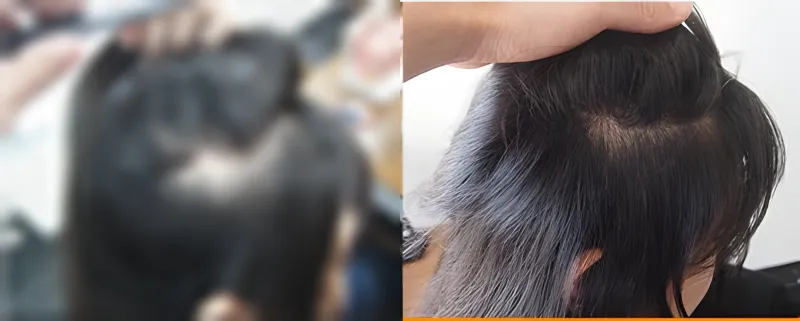 가려진 수술 전 사진